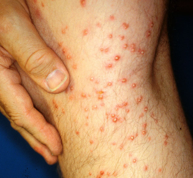 Fire ant bite and sting symptoms are pain, burning, swelling and redness 