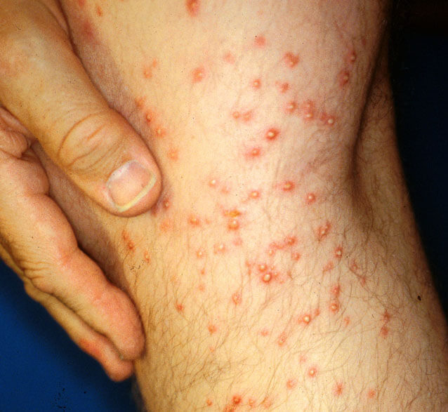 Fire ant bite and sting symptoms are pain, burning, swelling and redness