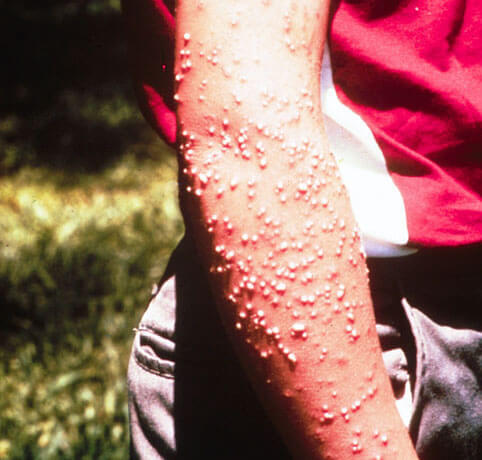 ant stings and bites