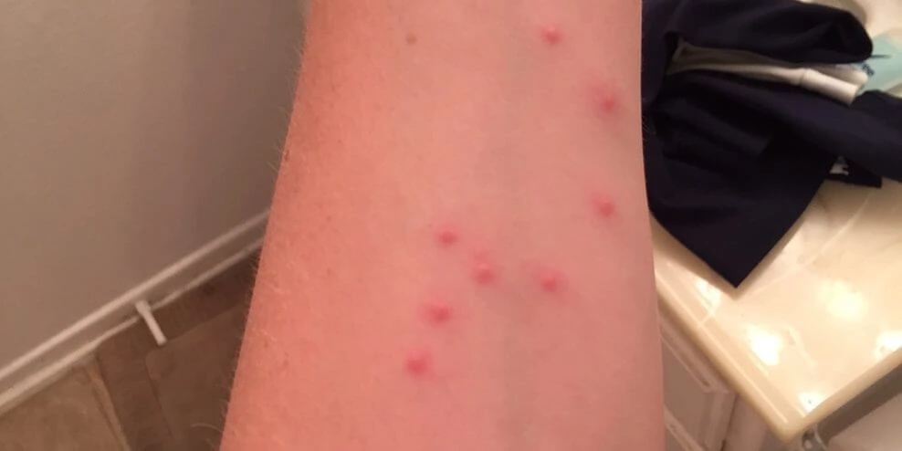 Multiple bed bug bites in a line or cluster
