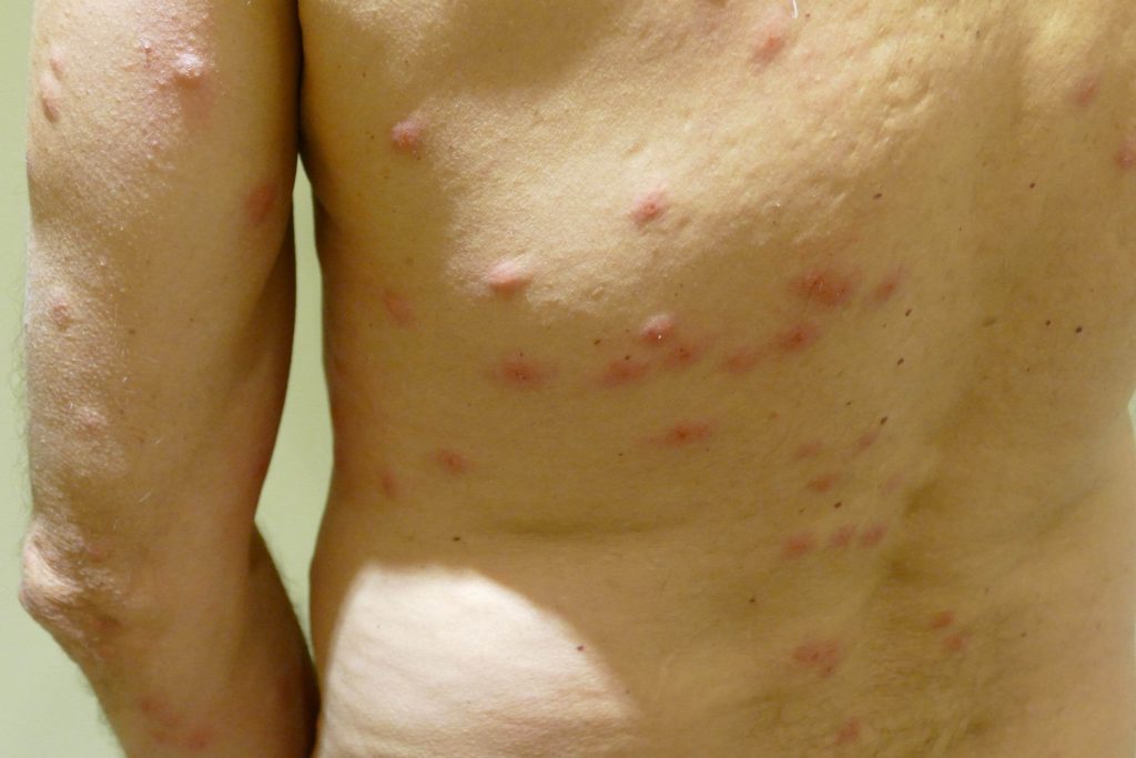 itchy bite marks from bedbugs