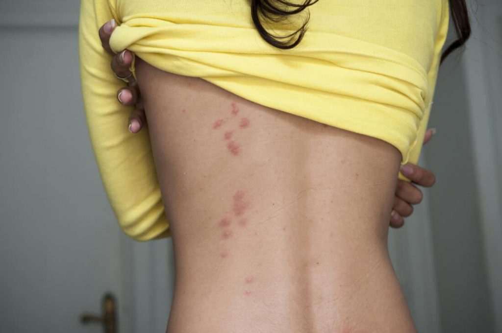 Bed bug bites look like this on a humans back.