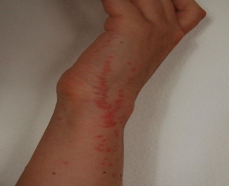 Bed bug bites around wrist