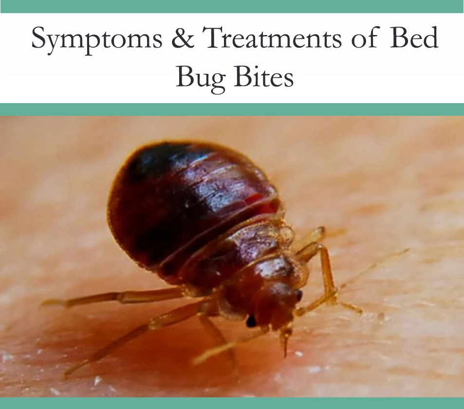 Bed Bug Bites Symptoms and Treatment