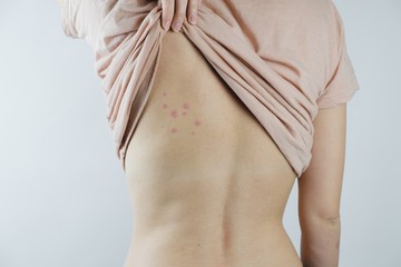 Damaged skin on female's back. Bedbug bites, moosquito bites or skin disease on human body