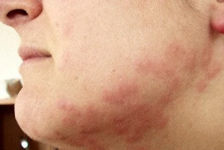 bed bug bits in human face
