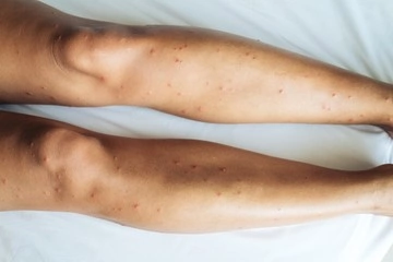 Female legs with many red spot and scar from sand fly bites