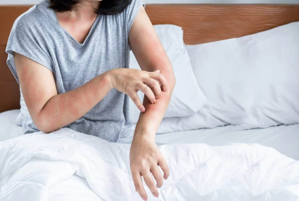 bed bug bites